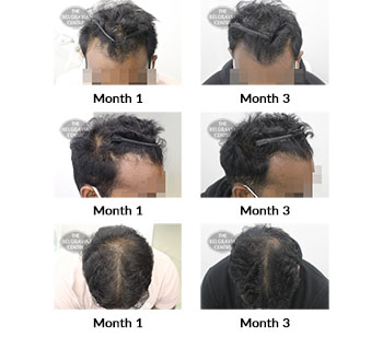 alert male pattern hair loss the belgravia centre 424317 08 09 2021