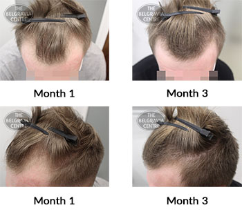 alert male pattern hair loss the belgravia centre 424469 10 09 2021 1