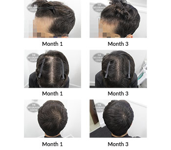 alert male pattern hair loss the belgravia centre 424898 14 09 2021