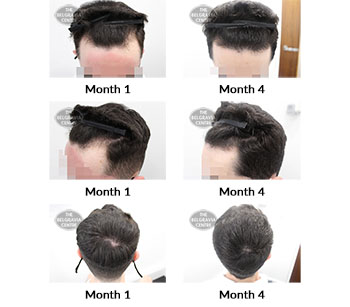 alert male pattern hair loss the belgravia centre 424051 17 09 2021