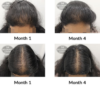 alert female pattern hair loss the belgravia centre 422798 24 09 2021