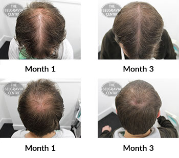 alert male pattern hair loss the belgravia centre 426437 28 10 2021