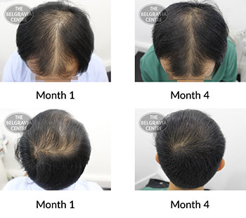 alert male pattern hair loss the belgravia centre 426242 02 11 2021