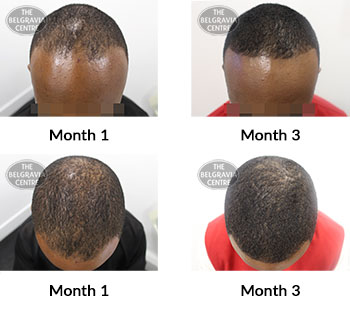 alert male pattern hair loss the belgravia centre 426450 04 11 2021