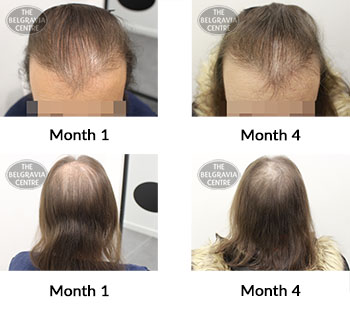 alert female pattern hair loss the belgravia centre 426133 05 11 2021