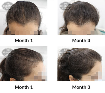 alert female pattern hair loss the belgravia centre 425702 09 11 2021