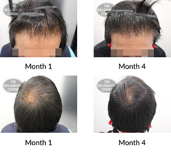 alert male pattern hair loss the belgravia centre 398161 15 11 2021