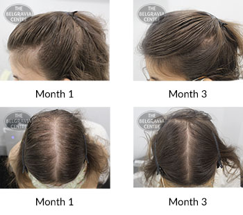 alert female pattern hair loss the belgravia centre 427218 131121