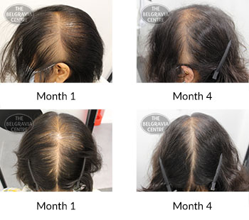 alert female pattern hair loss and diffuse thinning the belgravia centre 426438 111121