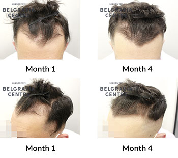 alert male pattern hair loss the belgravia centre 428696 071221