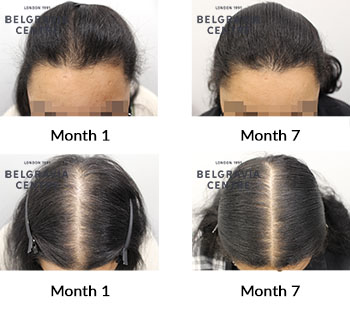 alert female pattern hair loss and diffuse thinning the belgravia centre 422038 230821