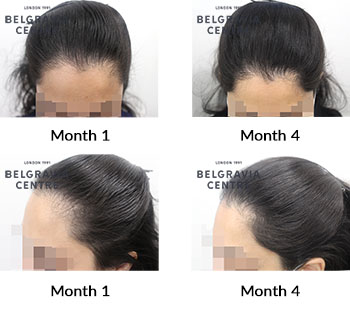 alert female pattern hair loss and diffuse thinning the belgravia centre 426908 131121