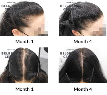alert female pattern hair loss and telogen effluvium the belgravia centre 429547 161221