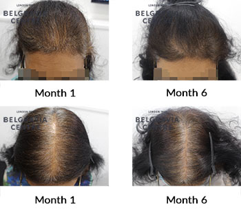 alert female pattern hair loss the belgravia centre 424669 161221