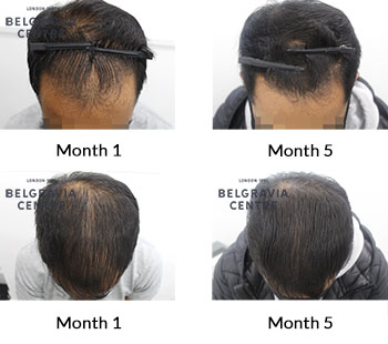 alert male pattern hair loss the belgravia centre 426573 151221