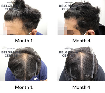 alert male pattern hair loss the belgravia centre 430061 221221