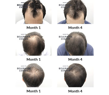 alert male pattern hair loss the belgravia centre 430544