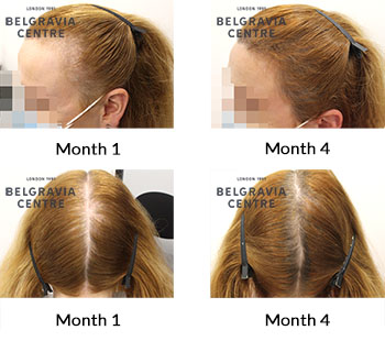 alert female pattern hair loss and post partum alopecia the belgravia centre 431774