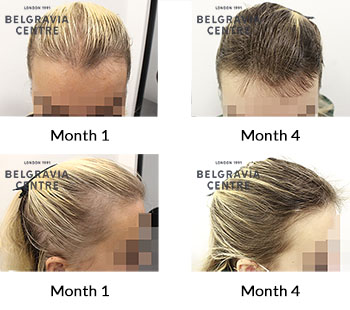 alert female pattern hair loss and telogen effluvium the belgravia centre 430221 1