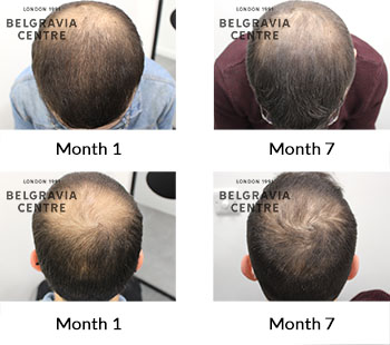 alert male pattern hair loss the belgravia centre 425652