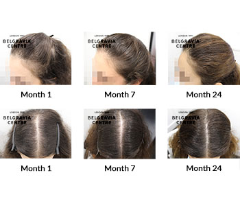 alert female pattern hair loss the belgravia centre 395879