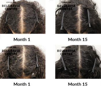 alert female pattern hair loss the belgravia centre 411285