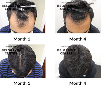 alert male pattern hair loss the belgravia centre 429877