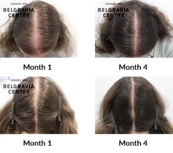 alert female pattern hair loss and diffuse thinning the belgravia centre 431610