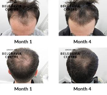 alert male pattern hair loss the belgravia centre 430518