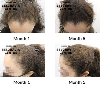 alert female pattern hair loss the belgravia centre 429480