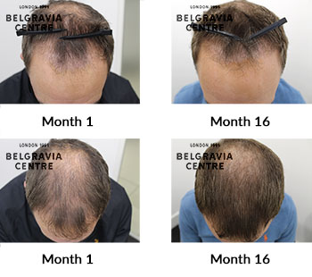 alert male pattern hair loss the belgravia centre 409981
