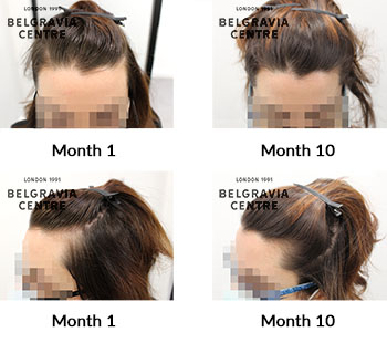 alert female pattern hair loss the belgravia centre 420397