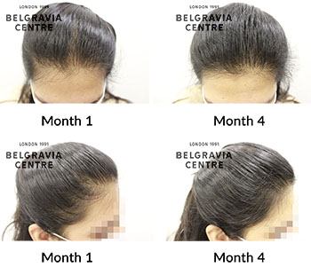 alert female pattern hair loss the belgravia centre 431677