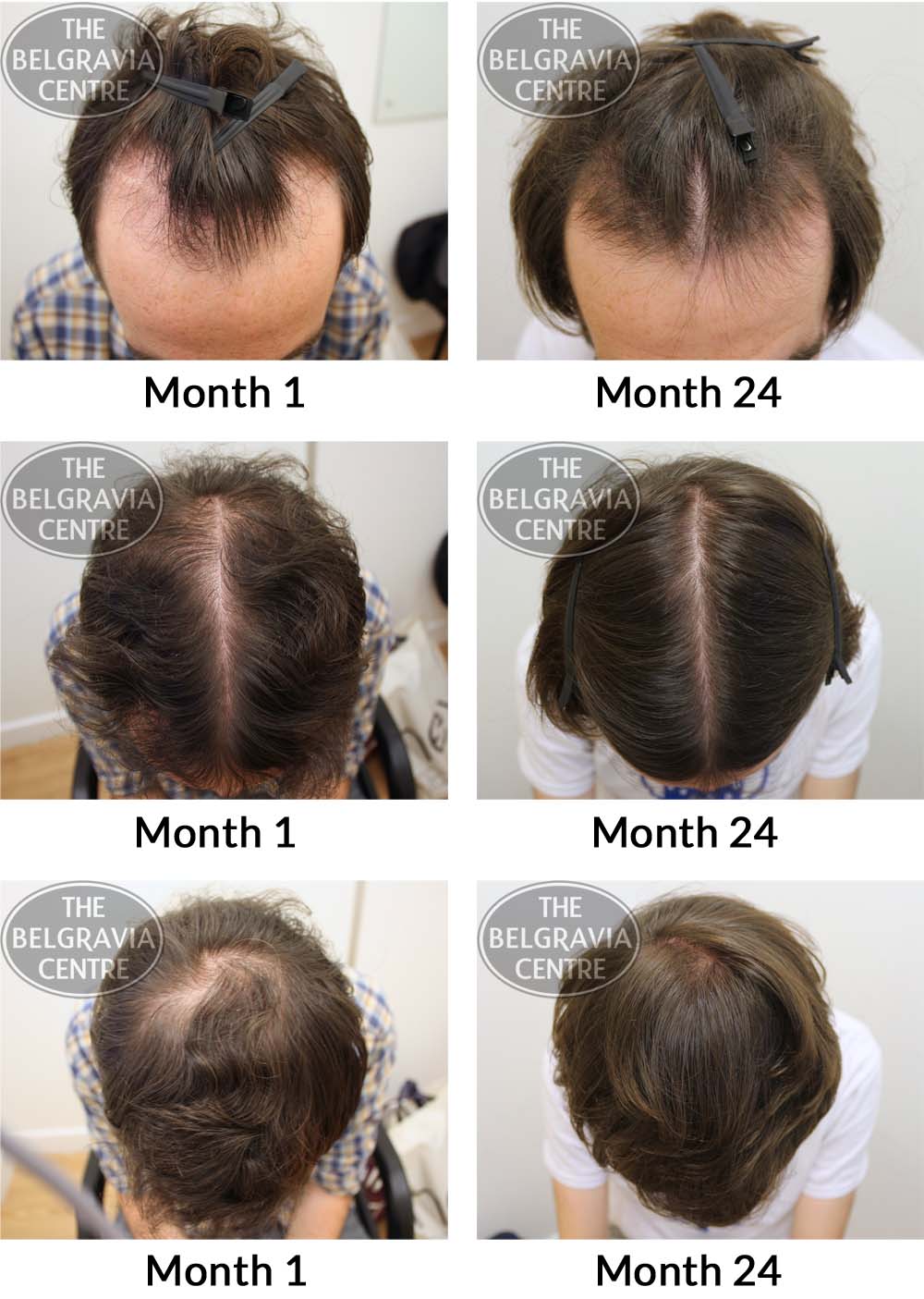 Male Pattern Hair Loss Photoscan The Belgravia Centre