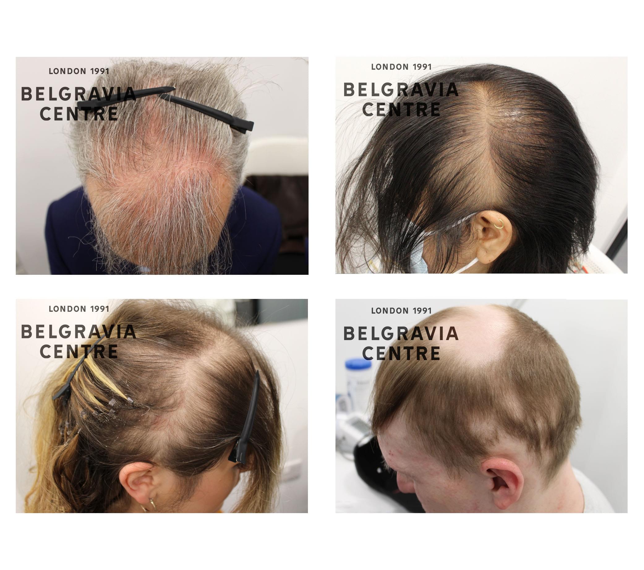 6 example images of hair loss